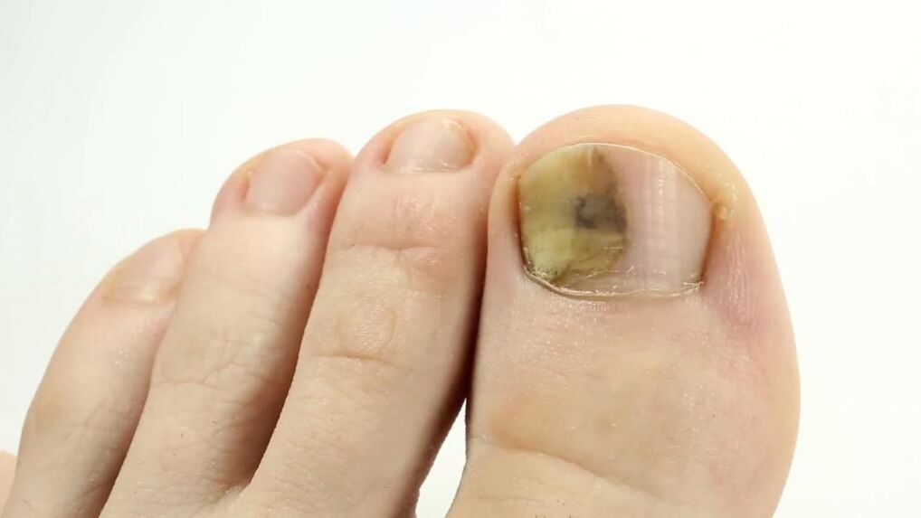 Appearance of toenail affected by fungus